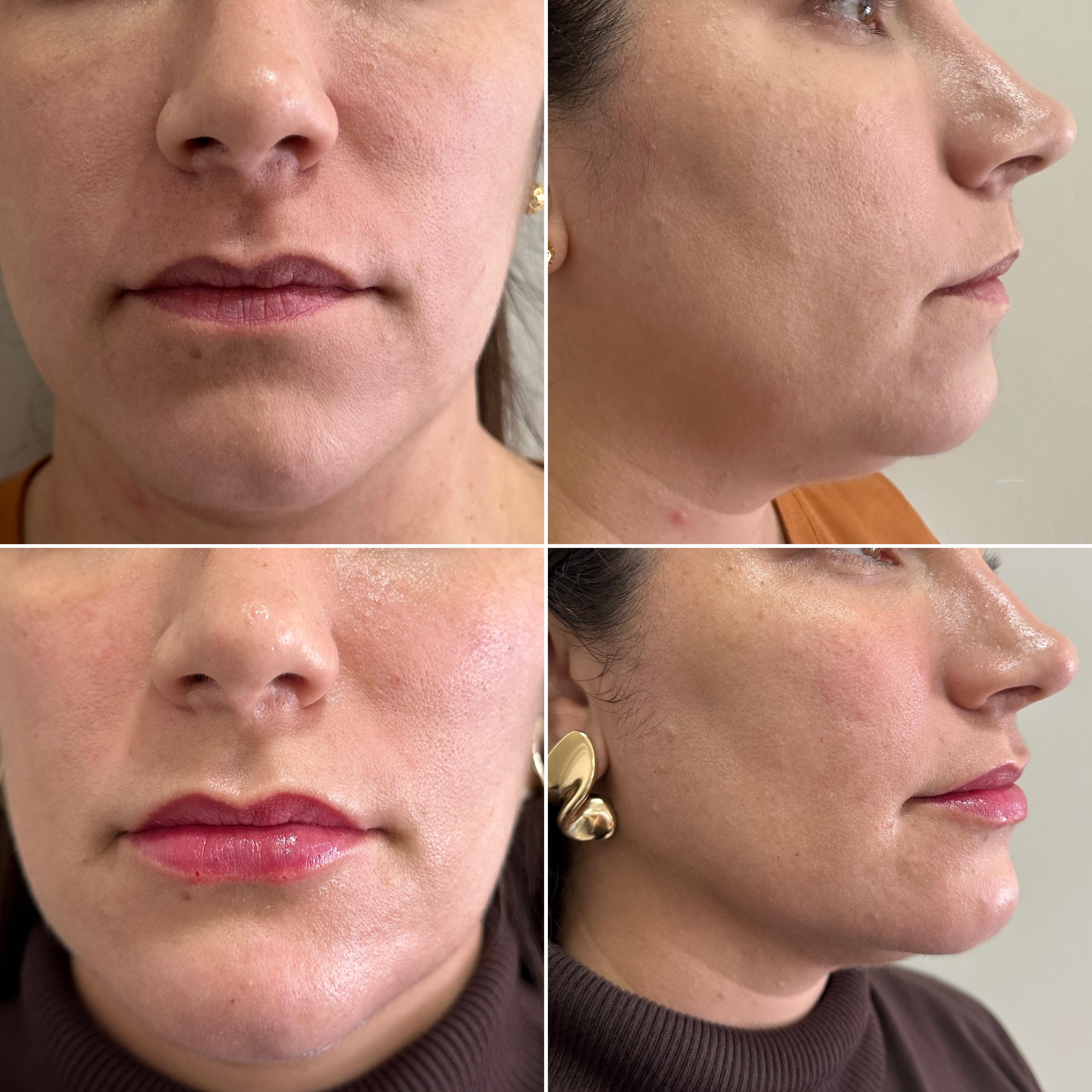 Harmonização Facial