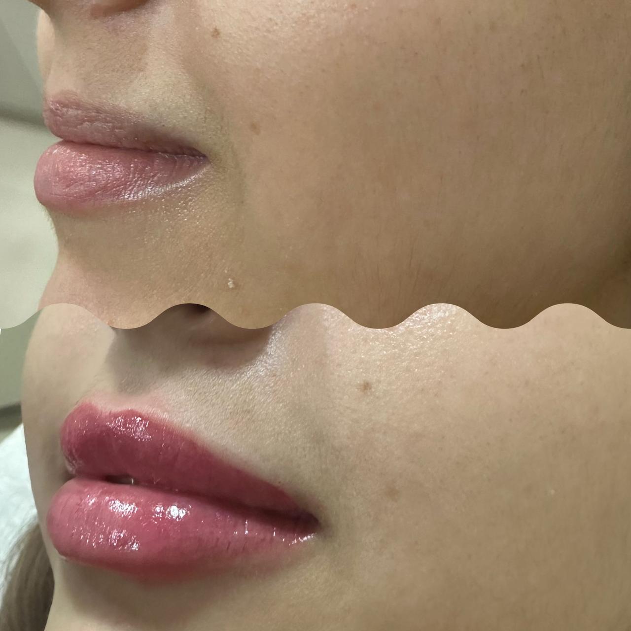 Preenchimento Labial